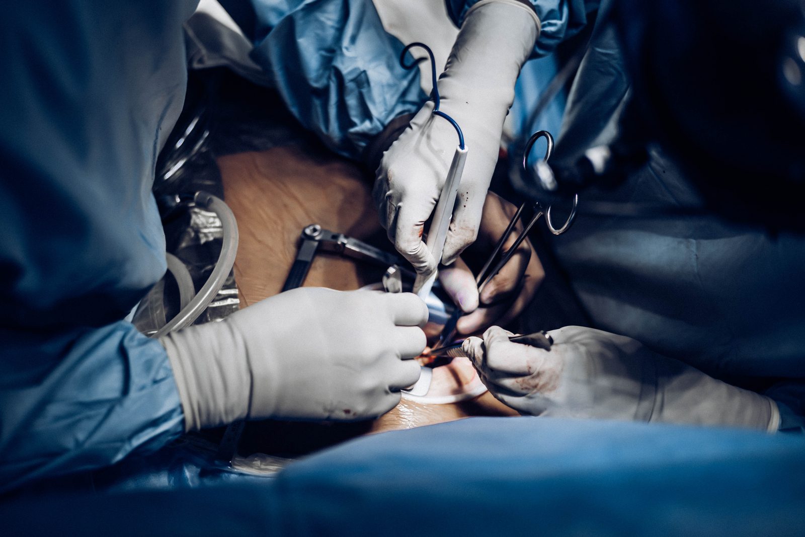 Open-heart cardiac surgery in progress